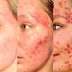 Best Makeup For Acne Prone Skin: Tips & FAQs