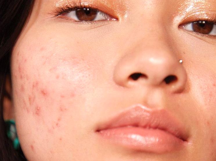 Makeup Tips for Those with Acne-Prone Complexions