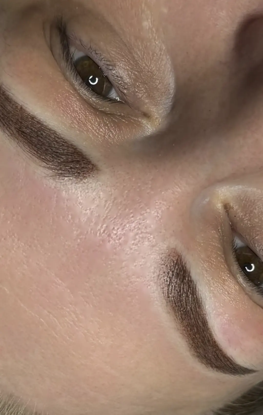 eyebrow laser tattoo removal