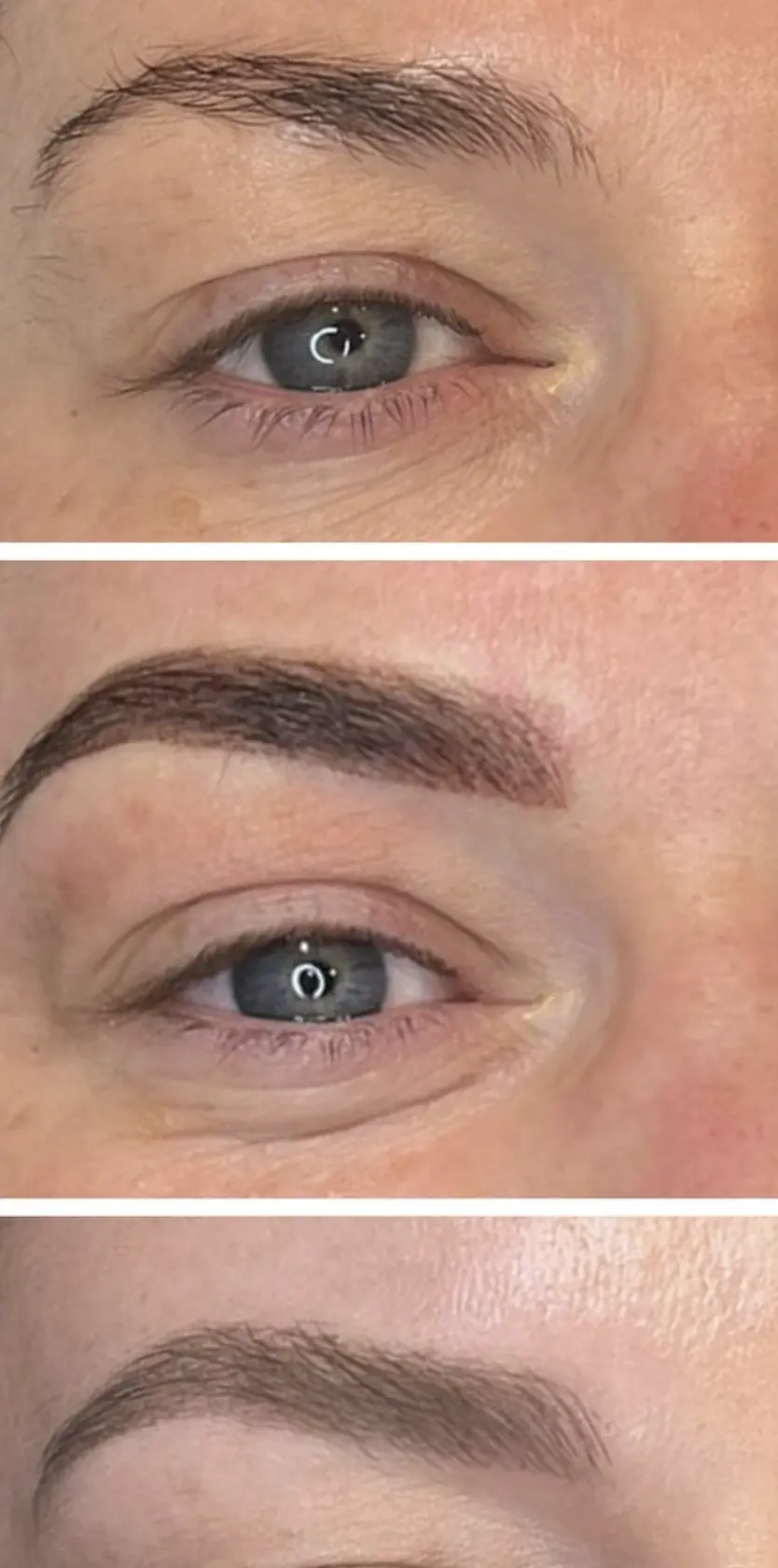 eyebrow tattoo laser removal