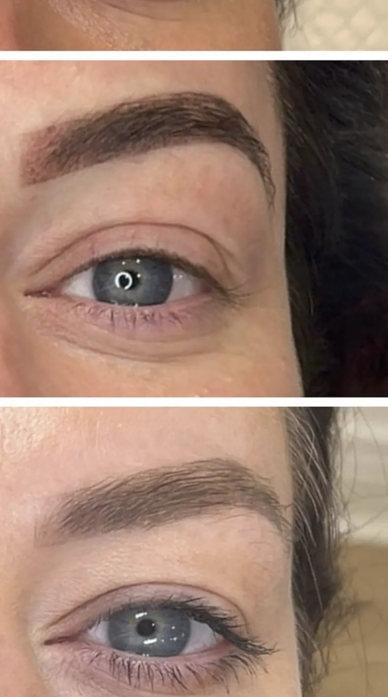 eyebrow tattoo removal before and after