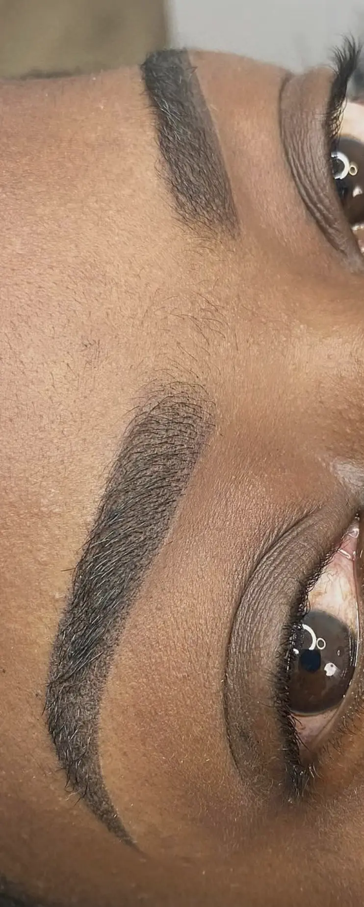 eyebrow tattoo removal gold coast